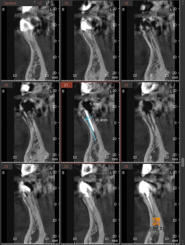 식립 부위의 CBCT 단면 영상 - 좁은 골폭을 보인다