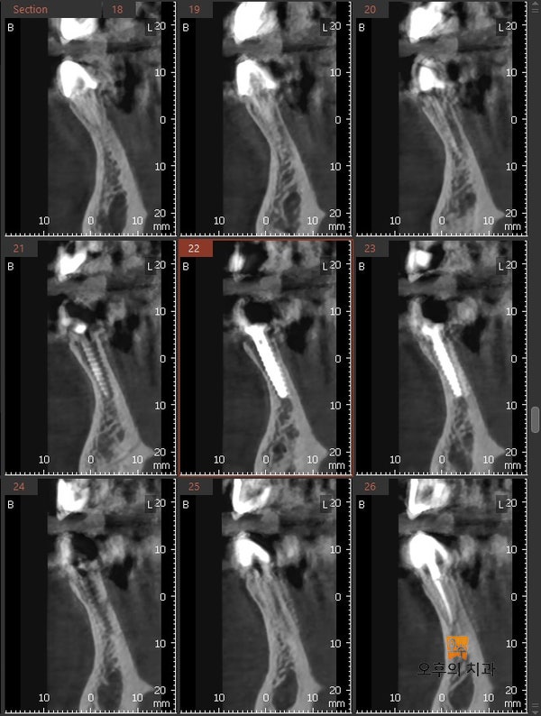 식립 후 CBCT 단면 영상