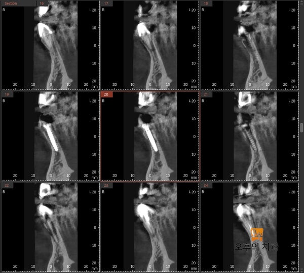 식립 한 달 후 CBCT 단면 영상