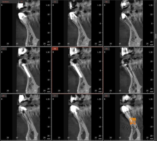 식립 6개월 후 CBCT 단면 영상