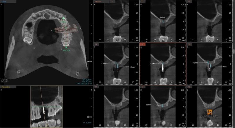 가이드핀 시적 후 촬영한 CBCT 단면 영상