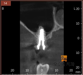 임플란트 식립 후 CBCT 단면 영상