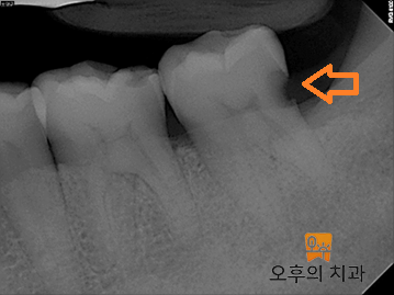 잇몸 아래 충치가 보이는 치근단 엑스레이