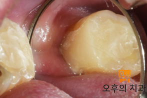 치관연장술 후 격리 상태에서 수복 치료