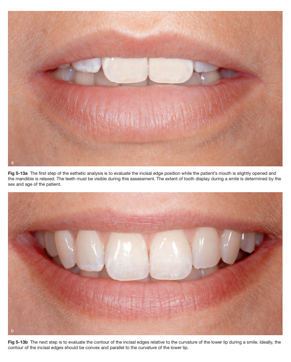 p.136, Otto Z, Marc H, Plastic-Esthetic Periodontal and Implant Surgery: A Microsurgidcal Approach, Quintessence