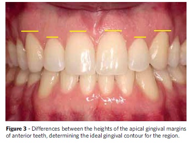 Mayra S, Roberto C, Telma A, Gingival esthetics: an orthodontic and periodontal approach, Dental Press J. Orthod. 17(5), 2012