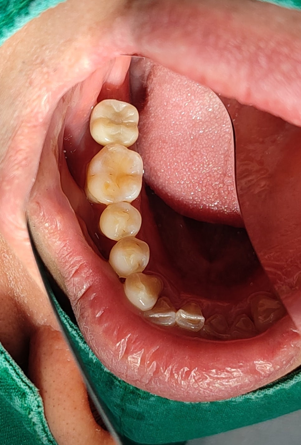 좌측 PMMA 보철물 우측 최종 지르코니아 보철물.