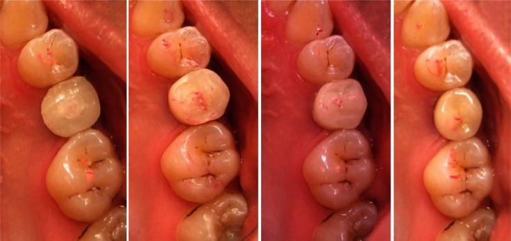 Ghoveizi, Rahab, et al. "A radiographic comparison of progressive and conventional loading on crestal bone loss and density in single dental implants: a randomized controlled trial study." Journal of Dentistry 10.2 (2013): 155.