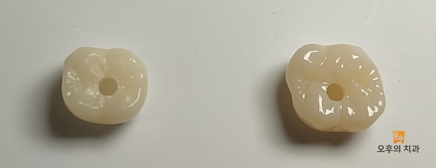 왼쪽이 PMMA, 오른쪽이 지르코니아 임플란트 보철물