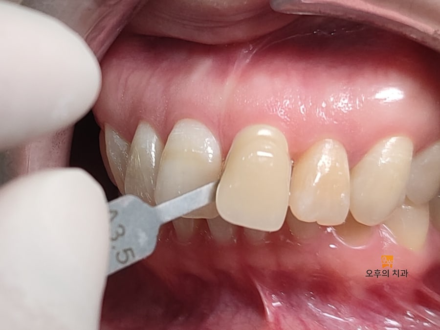 변색치아 색상 체크 A3.5보다 조금 더 어두운 것으로 측정됨.