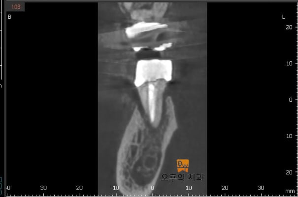 #37 치아의 CBCT 단면 사진