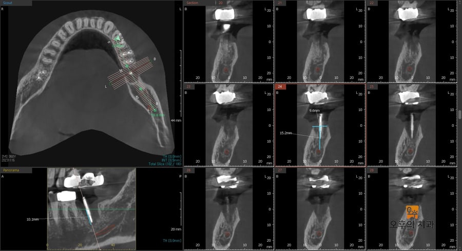 해당 부위 guide pin 시적 후 CBCT 단면 사진