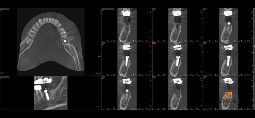 임플란트 식립 후 CBCT 단면 영상