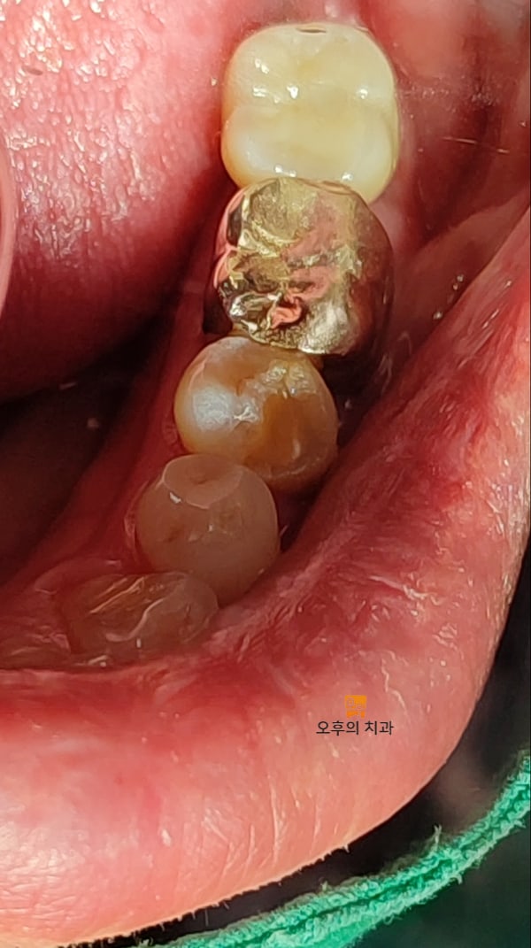 발치 전/ 발치 후 임플란트 수복 완료 후 구내 사진