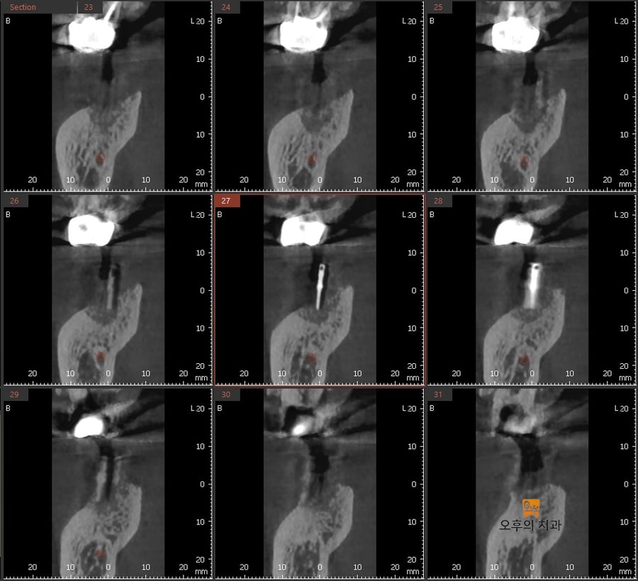 가이드핀 시적 후 촬영한 CBCT 단면 영상