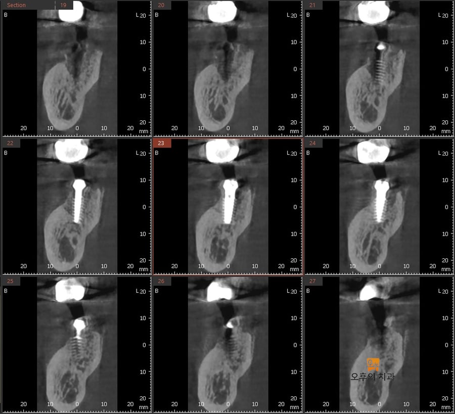 임플란트 식립 후 촬영한 CBCT 단면 영상