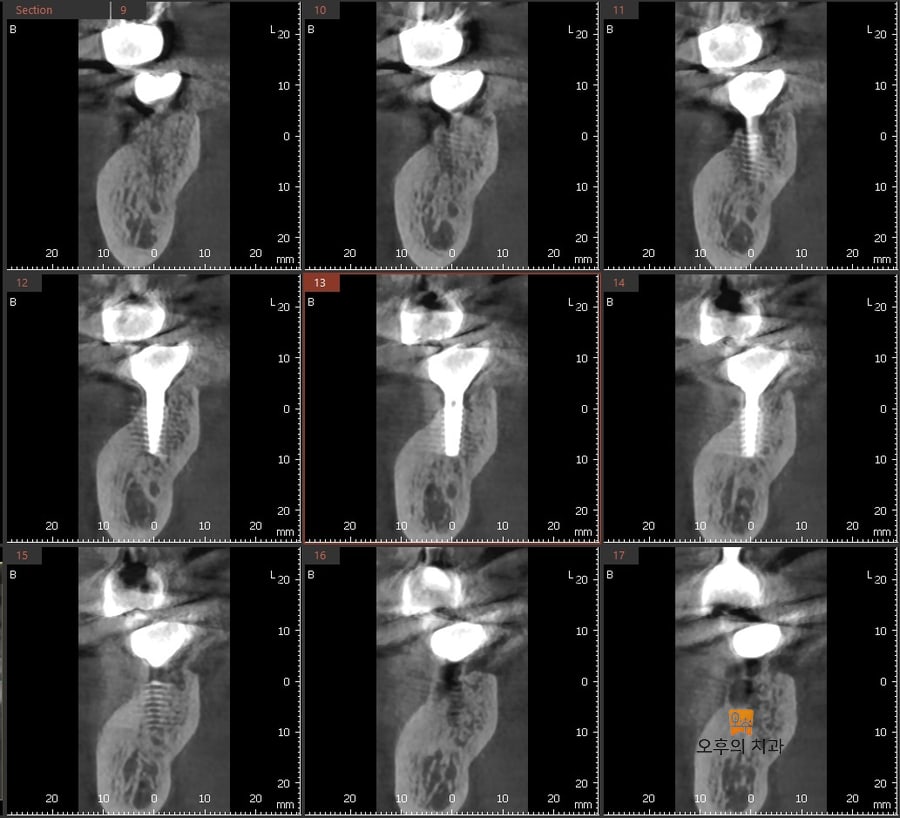 식립 1년 후 CBCT 영상