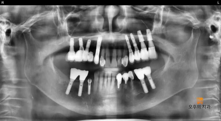 임플란트 식립 직후 파노라마 영상