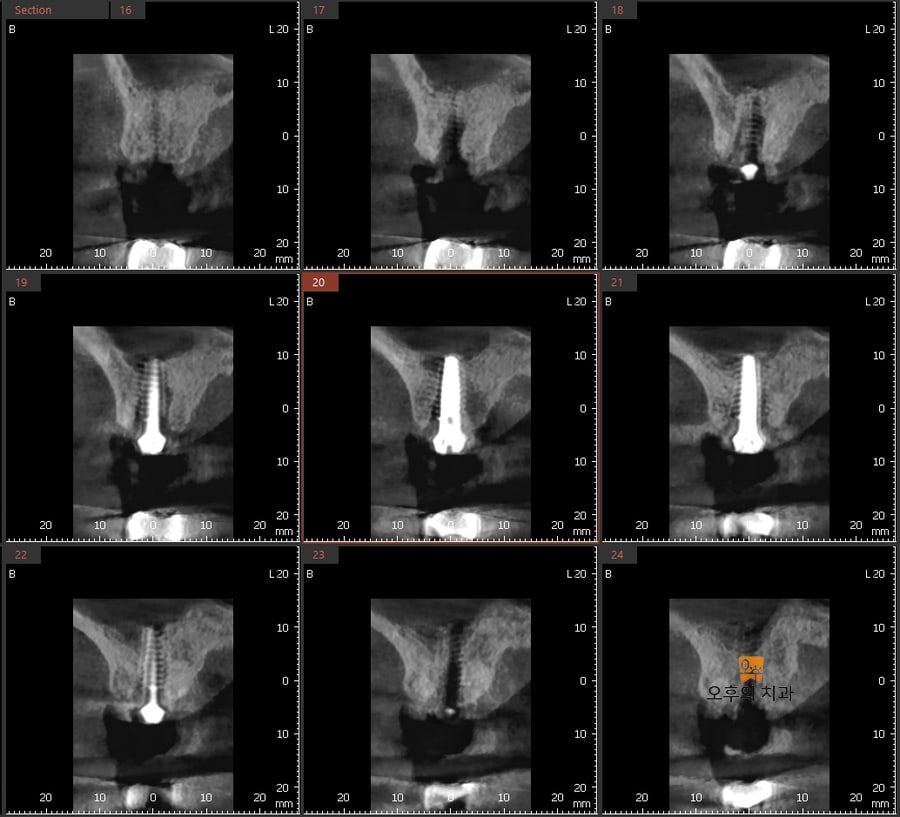 #26 식립 직후 CBCT 영상 단면
