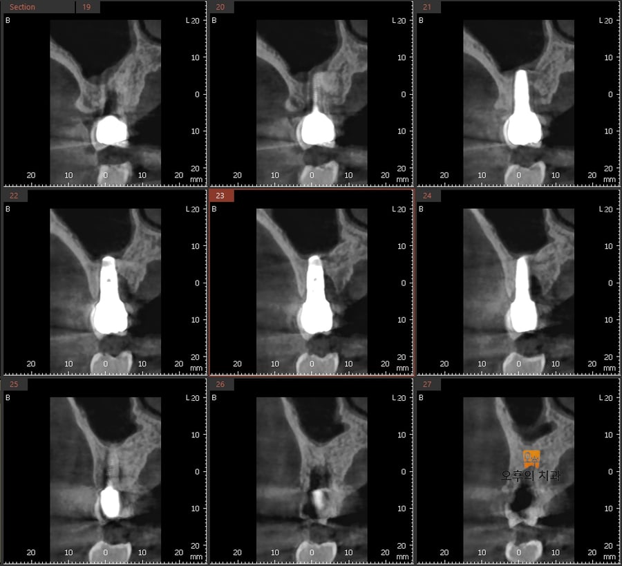 오래 전 식립한 #16 임플란트의 CBCT 영상 - 고정체 주변으로 심한 골소실이 확인된다