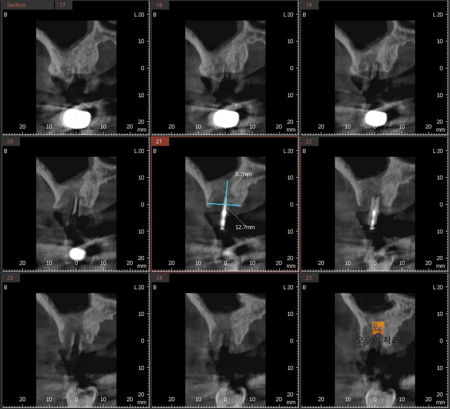 #16 임플란트 재식립 시 가이드핀 시적 후 CBCT 영상 단면