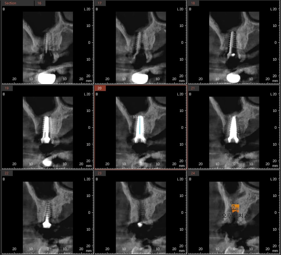 임플란트 식립 직후 CBCT 영상 단면