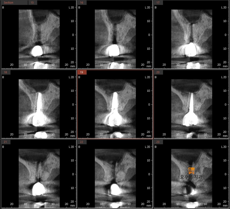 #26 임플란트의 CBCT 영상 단면