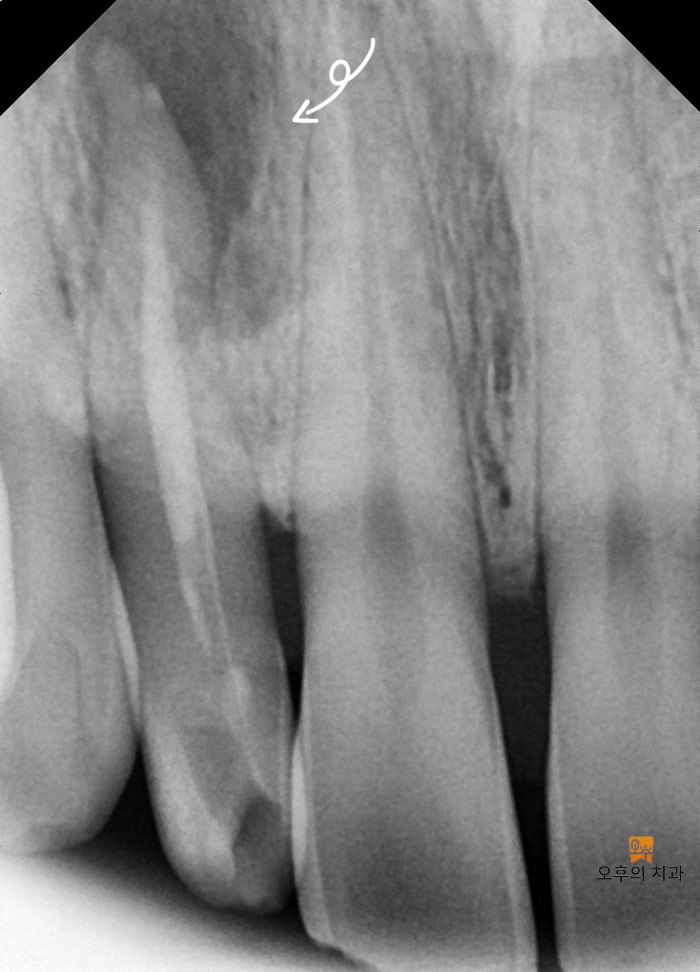 #12 치아의 치근단 영상과 CBCT 영상 단면
