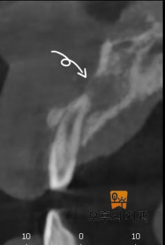 #12 치아의 치근단 영상과 CBCT 영상 단면