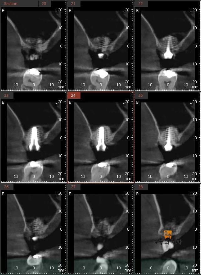 식립 후 CBCT 영상 단면