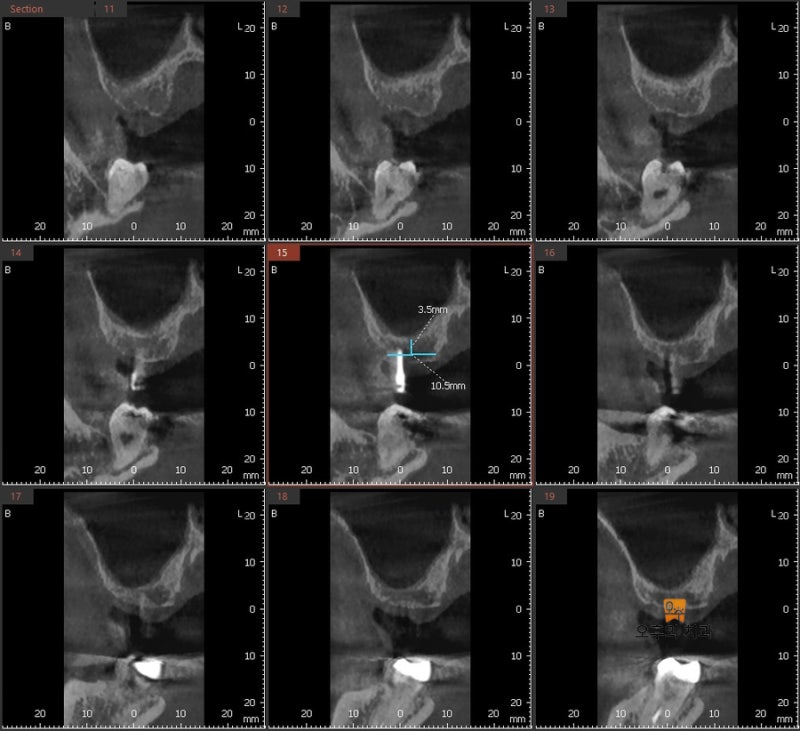 #27 가이드핀 시적 후 CBCT 영상 단면