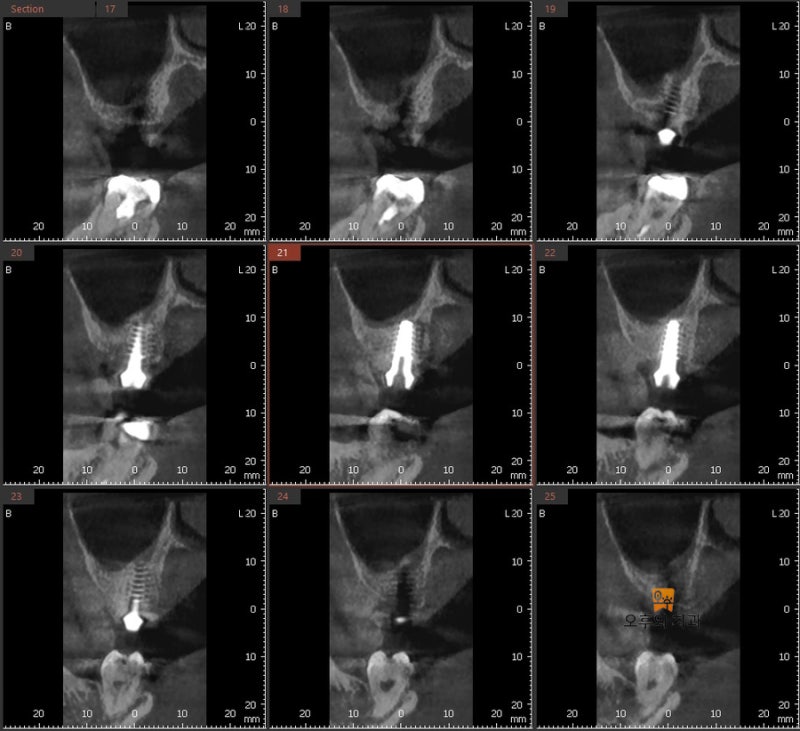 식립 후 CBCT 영상 단면