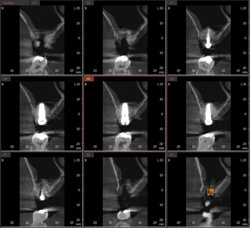 #16 임플란트 부위의 CBCT 영상 단면