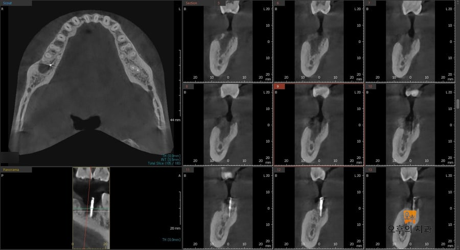 발치 한달 후 CBCT 영상 단면 - 만성 염증으로 인해 골치유가 느리다