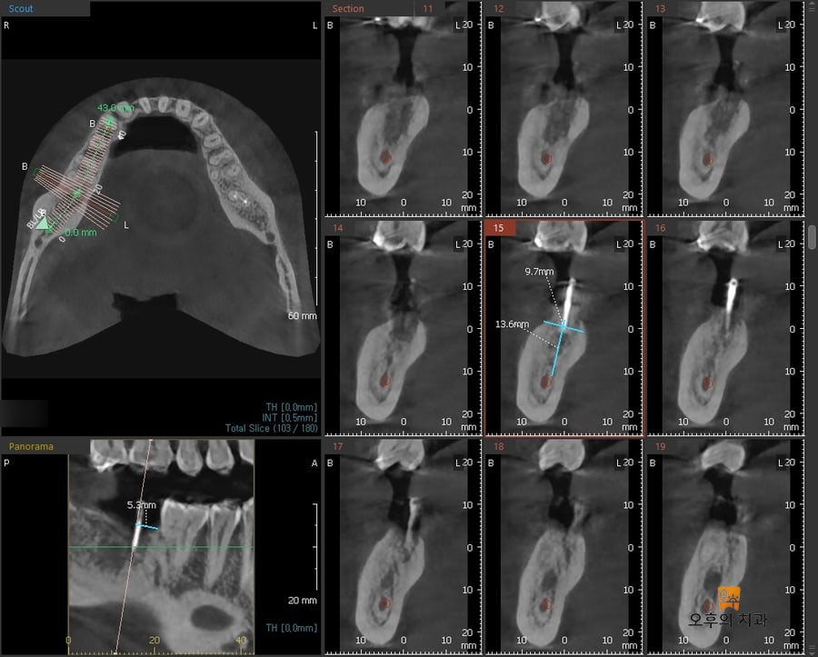 임플란트 식립 시 CBCT 영상 단면