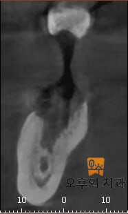 각각 발치 후 한달(좌), 그리고 6개월 후(우) CBCT 영상 단면