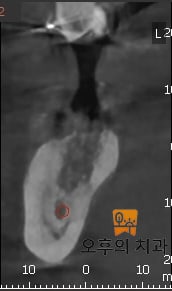 각각 발치 후 한달(좌), 그리고 6개월 후(우) CBCT 영상 단면