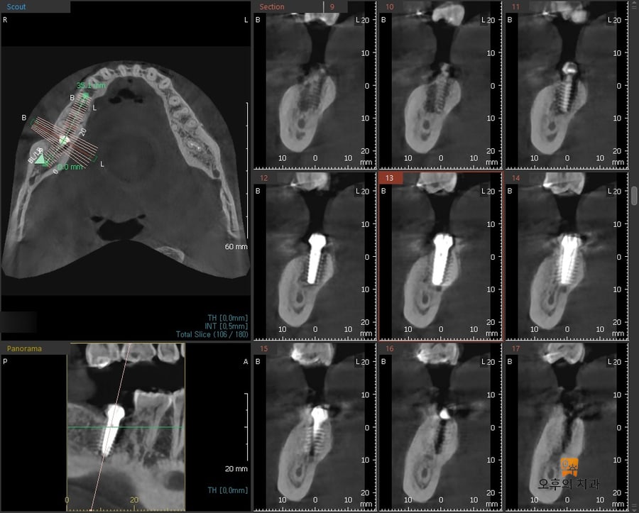 임플란트 식립 직후 CBCT 영상 단면