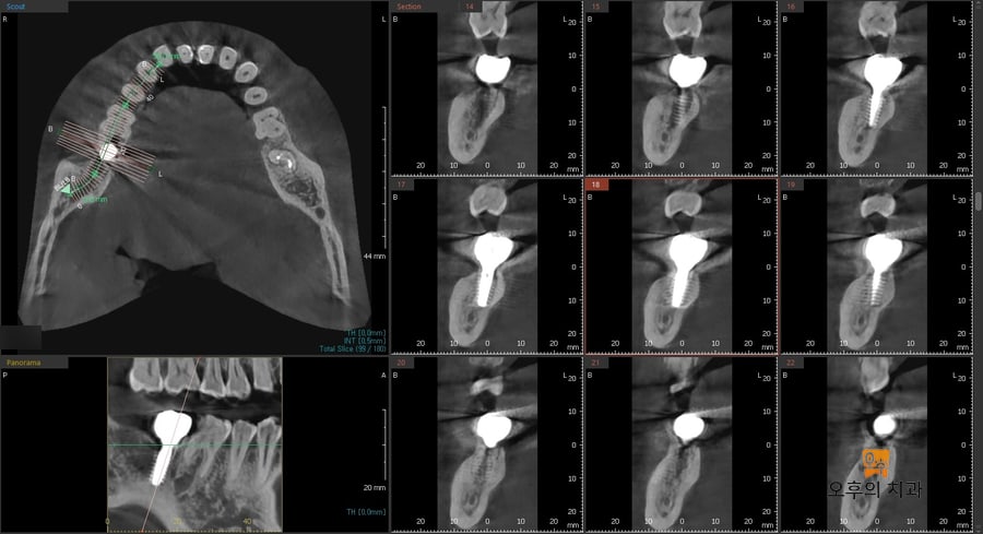 임플란트 식립 1년 이상이 경과된 후 CBCT 영상 단면