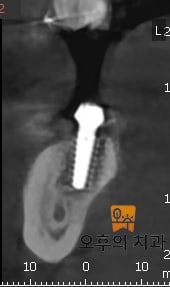 임플란트 식립 직후(좌)와 1년 이상 경과된 이후(우) CBCT 영상 단면의 비교