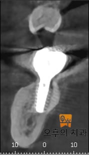 임플란트 식립 직후(좌)와 1년 이상 경과된 이후(우) CBCT 영상 단면의 비교