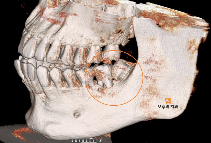 CBCT 영상