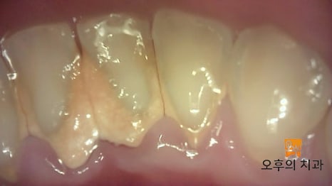 세균을 탐지하는 큐레이로 치석을 촬영한 사진
