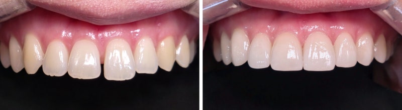 Before(좌) - After(우) 정면뷰 비교