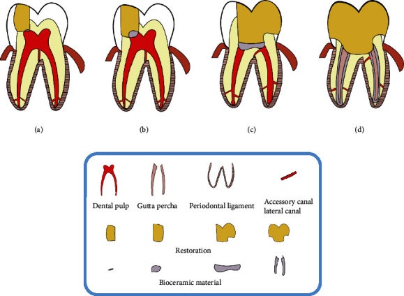 (a) Direct pulp capping, (b) partial pulpotomy, (c) total pulpotomy, and (d) root canal therapy(신경치료)