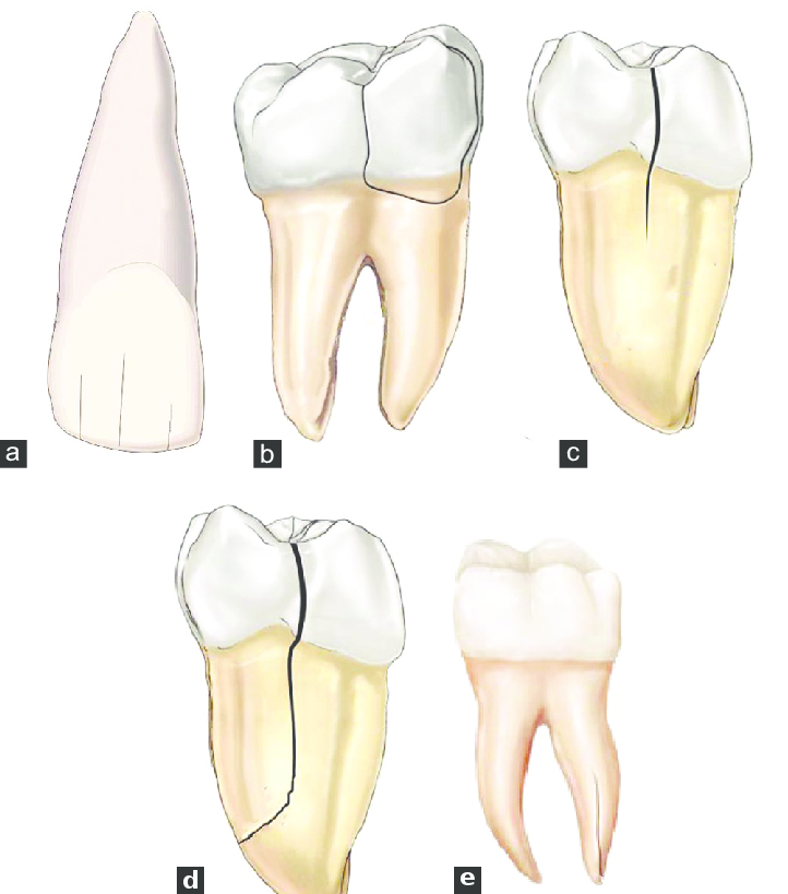 a. Craze line b.Fractured cusp c.Cracked tooth d.Split tooth e. Vertical root fracture