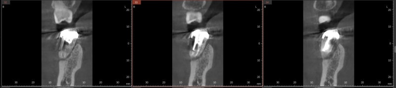 초진 시 CBCT 영상 단면 - 치근을 따라 광범위한 골소실이 관찰