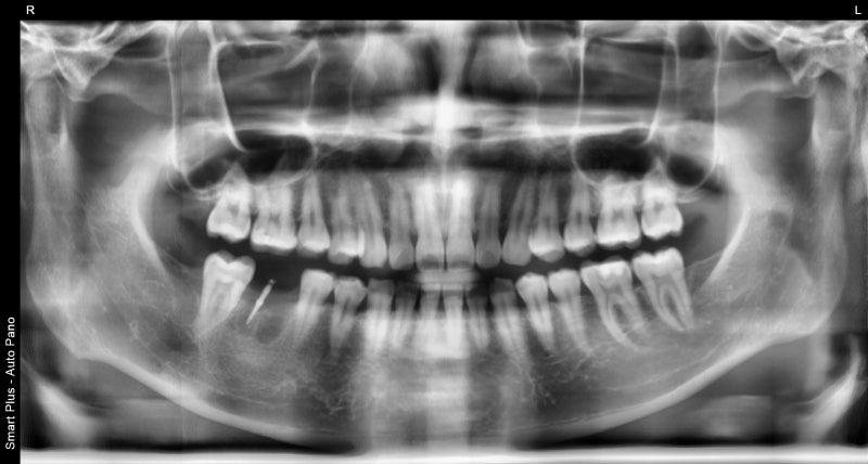 임플란트 식립 계획을 위한 CBCT 영상 - 가이드핀을 시적하여 잔존골 높이와 하치조신경관까지의 거리를 측정하였다