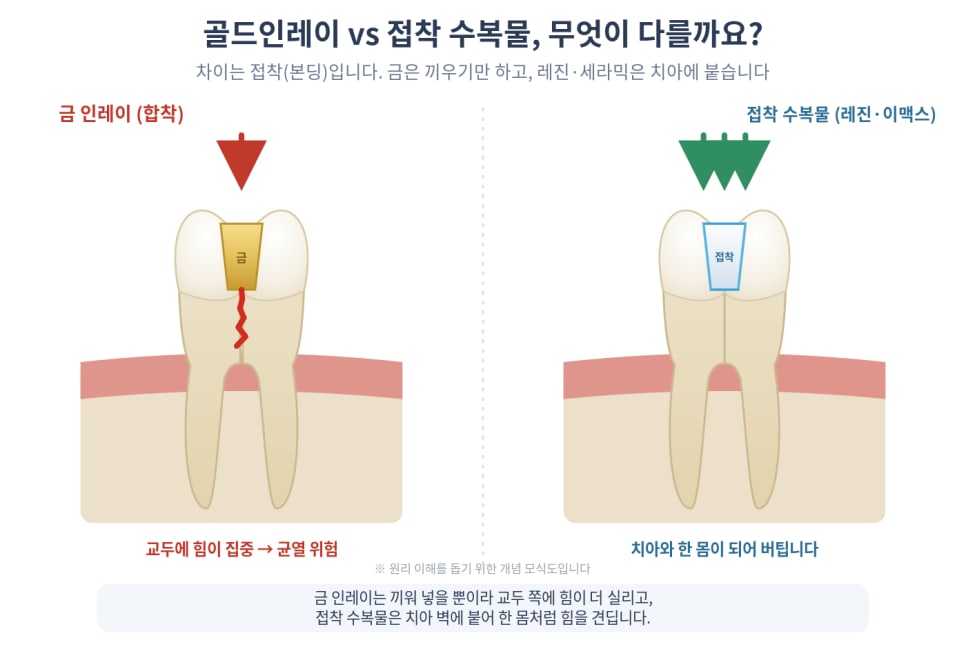 골드인레이 대신 접착 수복물을 권하는 이유
