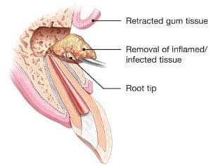 치근단 절제술 (Apicoectomy) 모식도